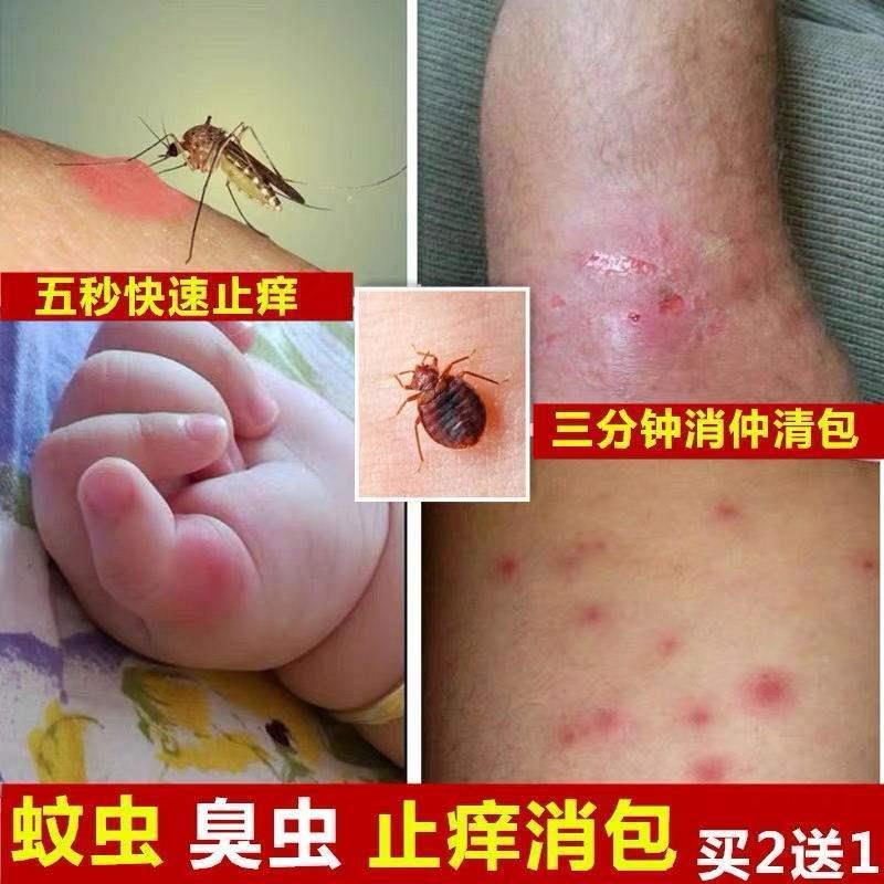 跳蚤臭虫蚊虫叮咬外用皮肤过敏瘙痒红肿止痒儿童成人药膏;