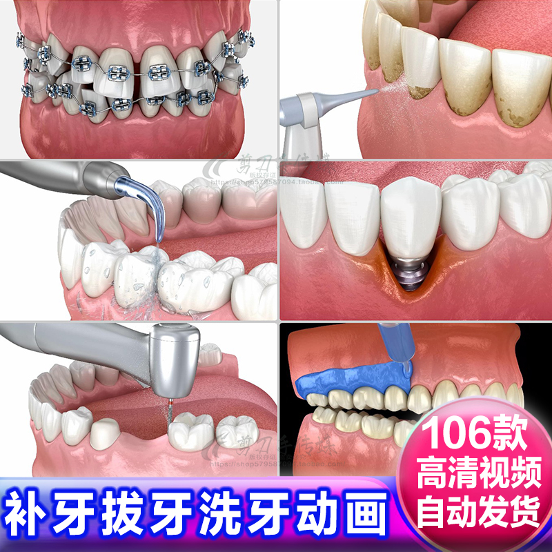 口腔卫生镶假牙拔种植牙齿3D模型演示动画洗牙科医疗健康视频素材