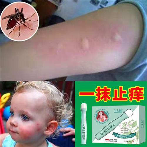 儿童婴儿防跳g蚤蚊子蚊虫叮咬止痒消儿童肿成人宝宝婴儿蚊子药膏